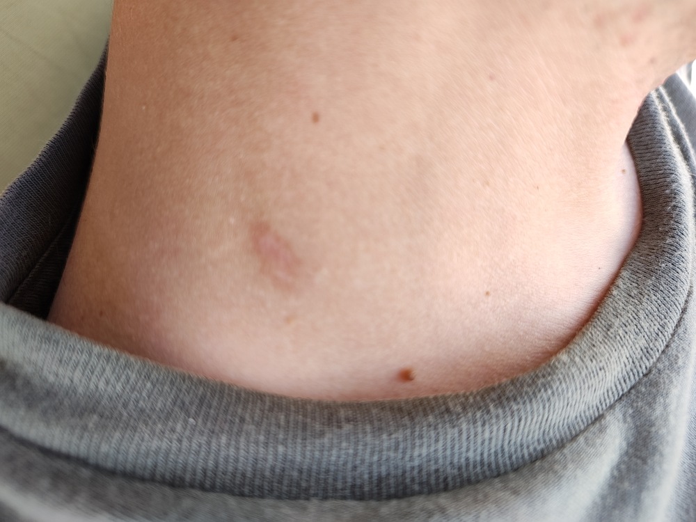 Patchs Traitants ZDROVIT Contre Les Papillomes (acrochordons) - 6 Jours - Neuf