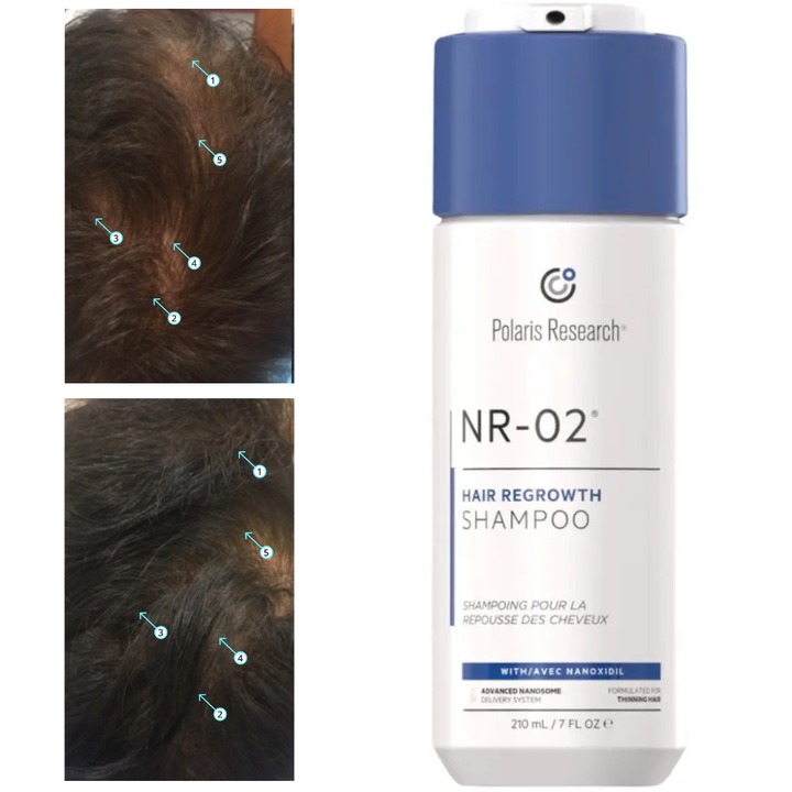 Sampon – pentru alopecie androgenetica, Tratament Impotriva Caderii Parului, Cu Nanoxidil, Tripeptide de Cupru si Serenoa Serrulata, Fortifiant si Hidratant, Pentru Toate Tipurile de Par, Unisex, 210 ml, DS Labs Polaris NR-02®