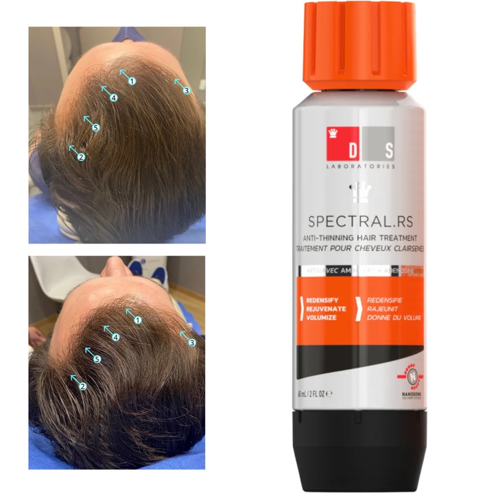 Spectral.RS Ser Antisubtiere fire de par, tratament pentru Intarirea si Regenerarea Firului de Par – Cu Capixyl, Adenozina, Retinol si Peptide, Impotriva Caderii Difuze si Subtierii Parului Cauzate de Dezechilibre Hormonale sau Deficit de Nutrienti, 60 ml