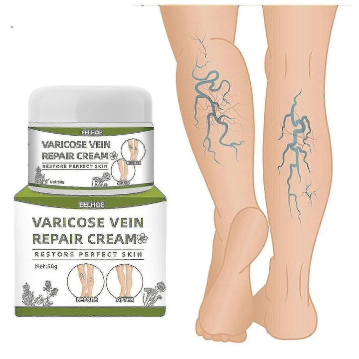 Visszérkrém, 50g, segít csökkenteni a visszér és a seprűvénák tüneteit, javítja a vérkeringést