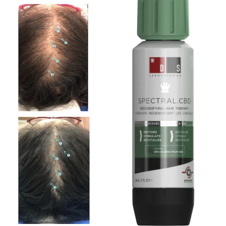 Ser cu Nanoxidil 5% Impotriva Caderii Parului – Tratament Avansat pentru Cresterea Densitatii si Volumului Parului, Calmarea Scalpului si Reducerea Sebumului, Formula Non-Grasa cu Sistem Nanosomic, Recomandata Dermatologic, 60 ml, Spectral DS LABS