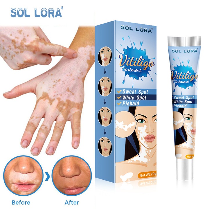 Fehérítő kenőcs vitiligo és bőrápolás céljára, helyi alkalmazású kenőcs