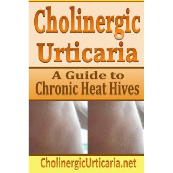 Cholinergic Urticaria: A Guide to Chronic Heat Hives, B. Page (Author)