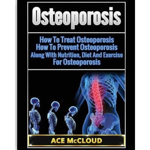 Osteoporosis: How to Treat Osteoporosis: How to Prevent Osteoporosis: Along with Nutrition, Diet and Exercise for Osteoporosis, Ace McCloud (Author)