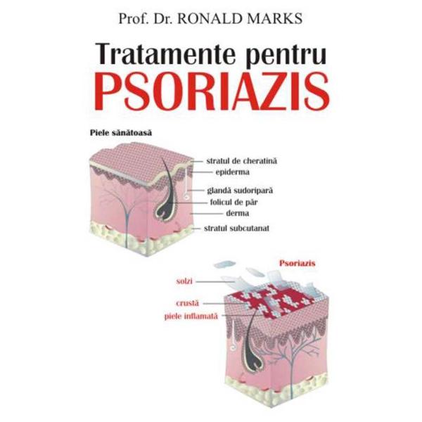 Tratamente pentru psoriazis - Ronald Marks