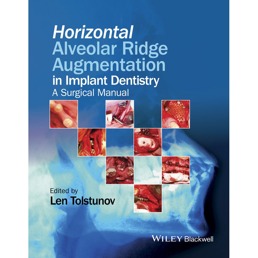 Horizontal Alveolar Ridge Augmentation in Implant Dentistry de Len Tolstunov