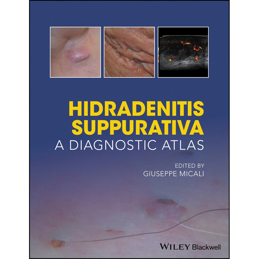 Hidradenitis Suppurativa de Giuseppe Micali