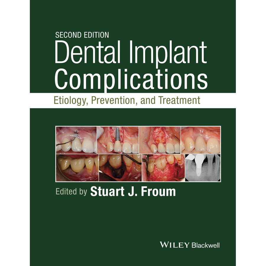 Dental Implant Complications de Stuart Froum