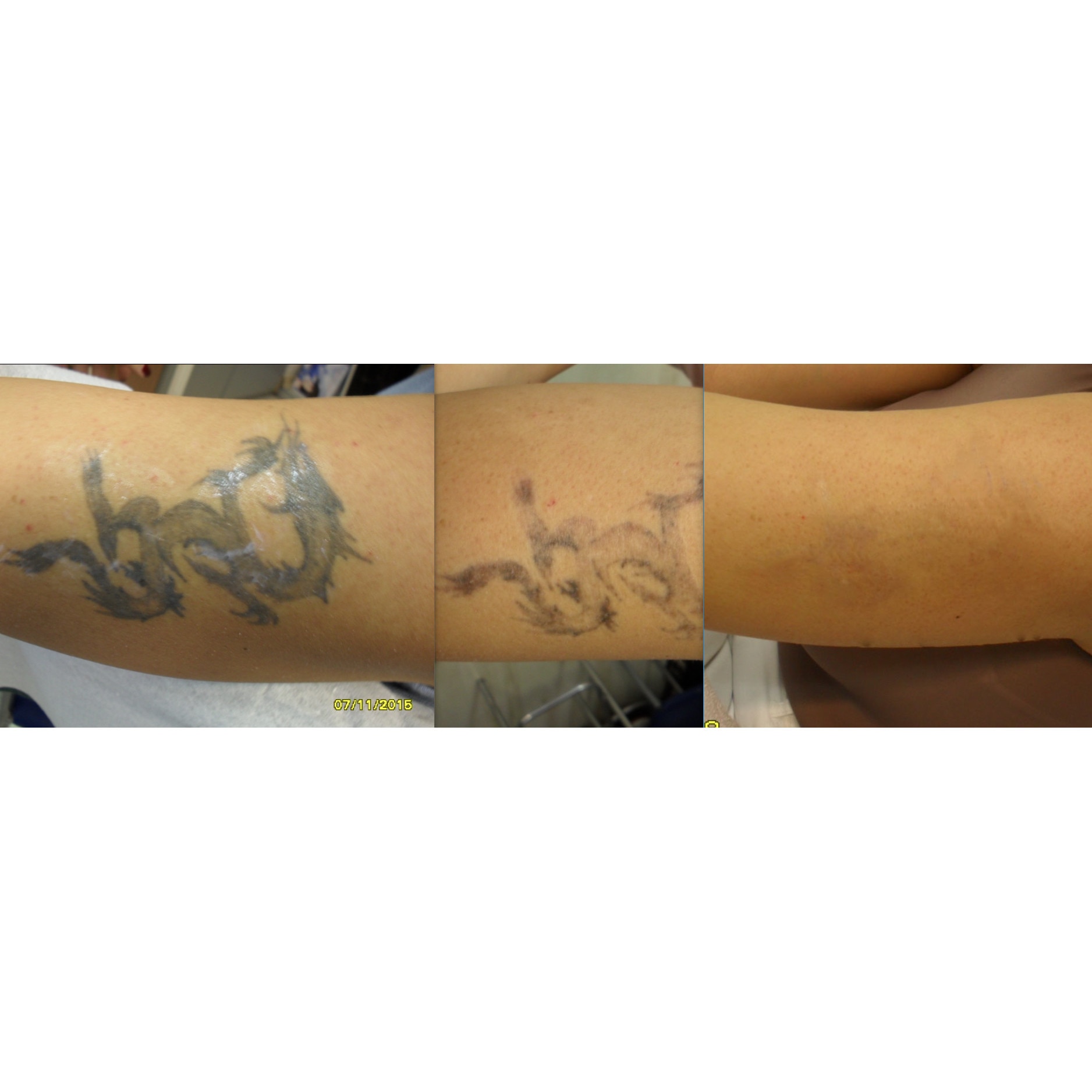 Tattoo Removal Treatments  Vamoose Tattoo Removal  Groupon