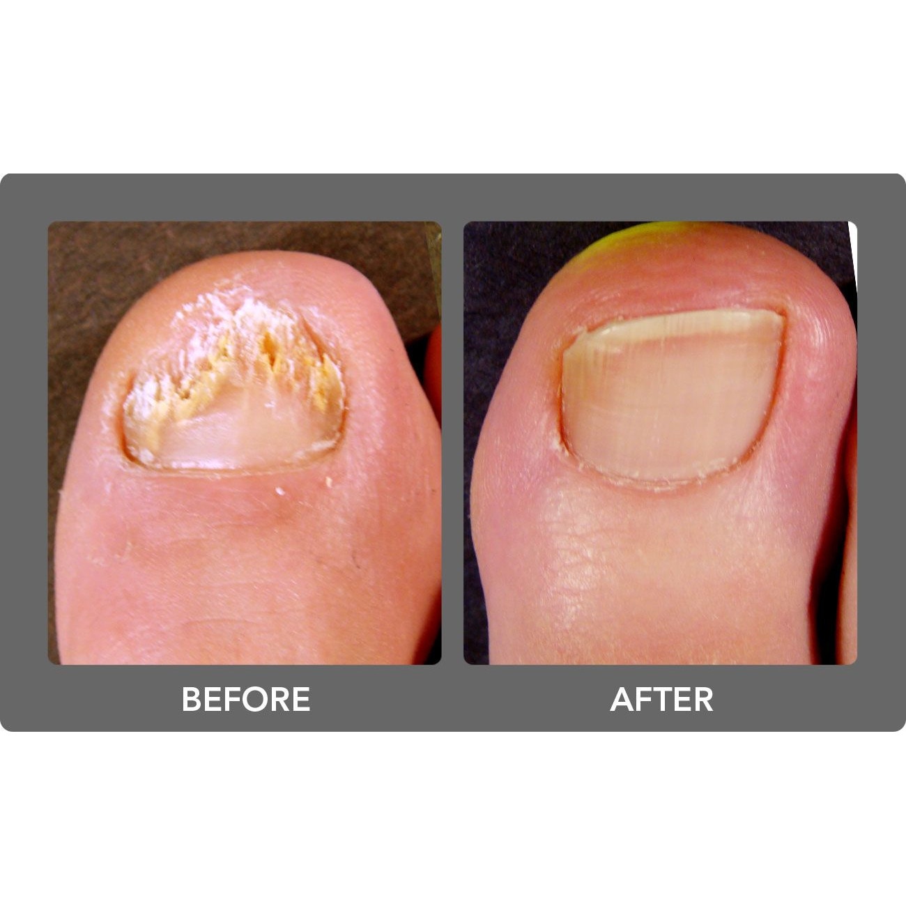 tratament cu creolină ciuperca unghiilor de la picioare