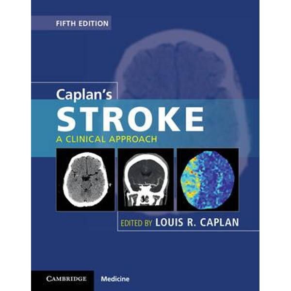 Caplan's Stroke