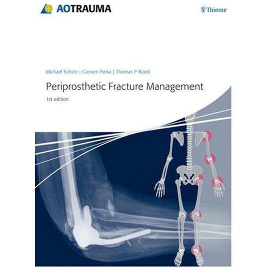 Periprosthetic Fracture Management de Michael Schuetz