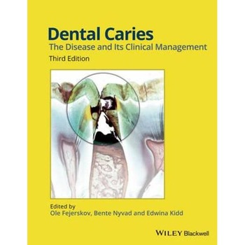 Dental Caries Dental Caries