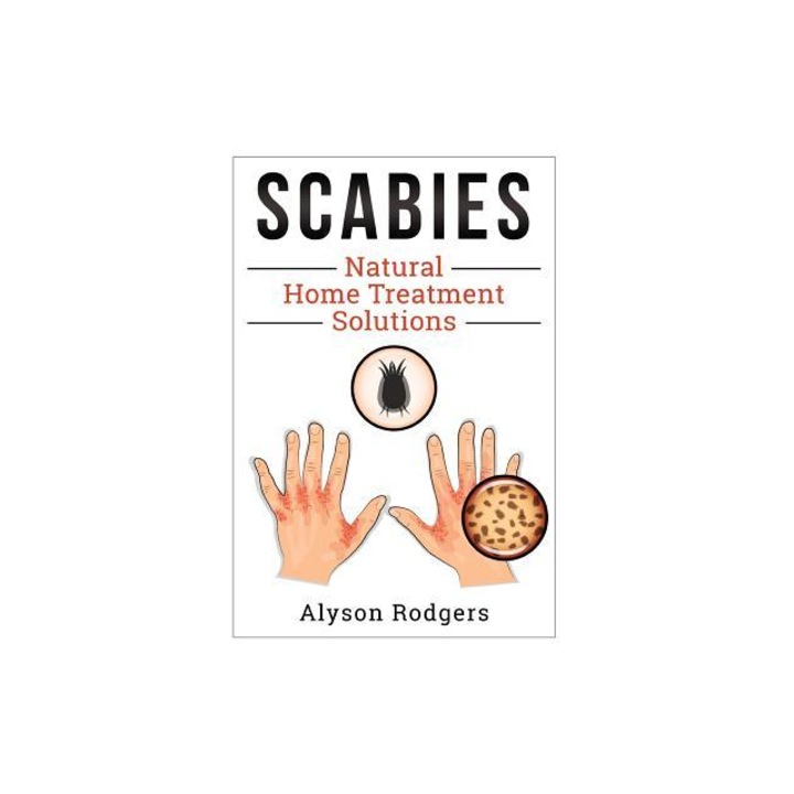 Scabies Natural Home Treatment Solution, Alyson Rodgers