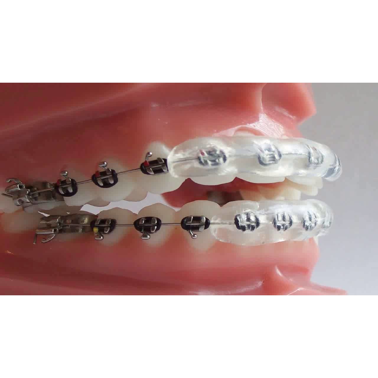 aparat dentar fals pret - www.ggxdtelecom.com 