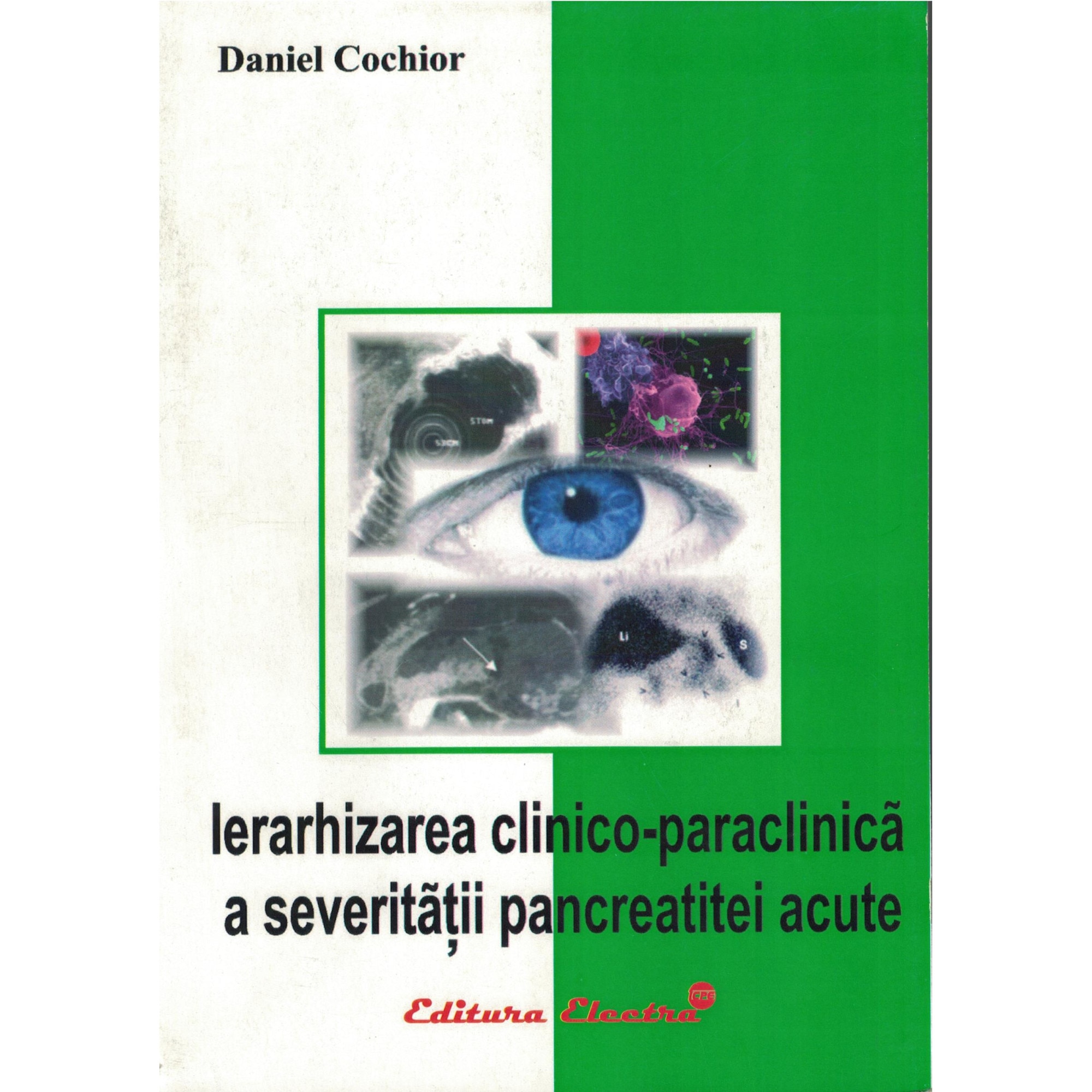Ierarhizarea clinico-paraclinica a severitatii pancreatitei acute - Daniel Cochior