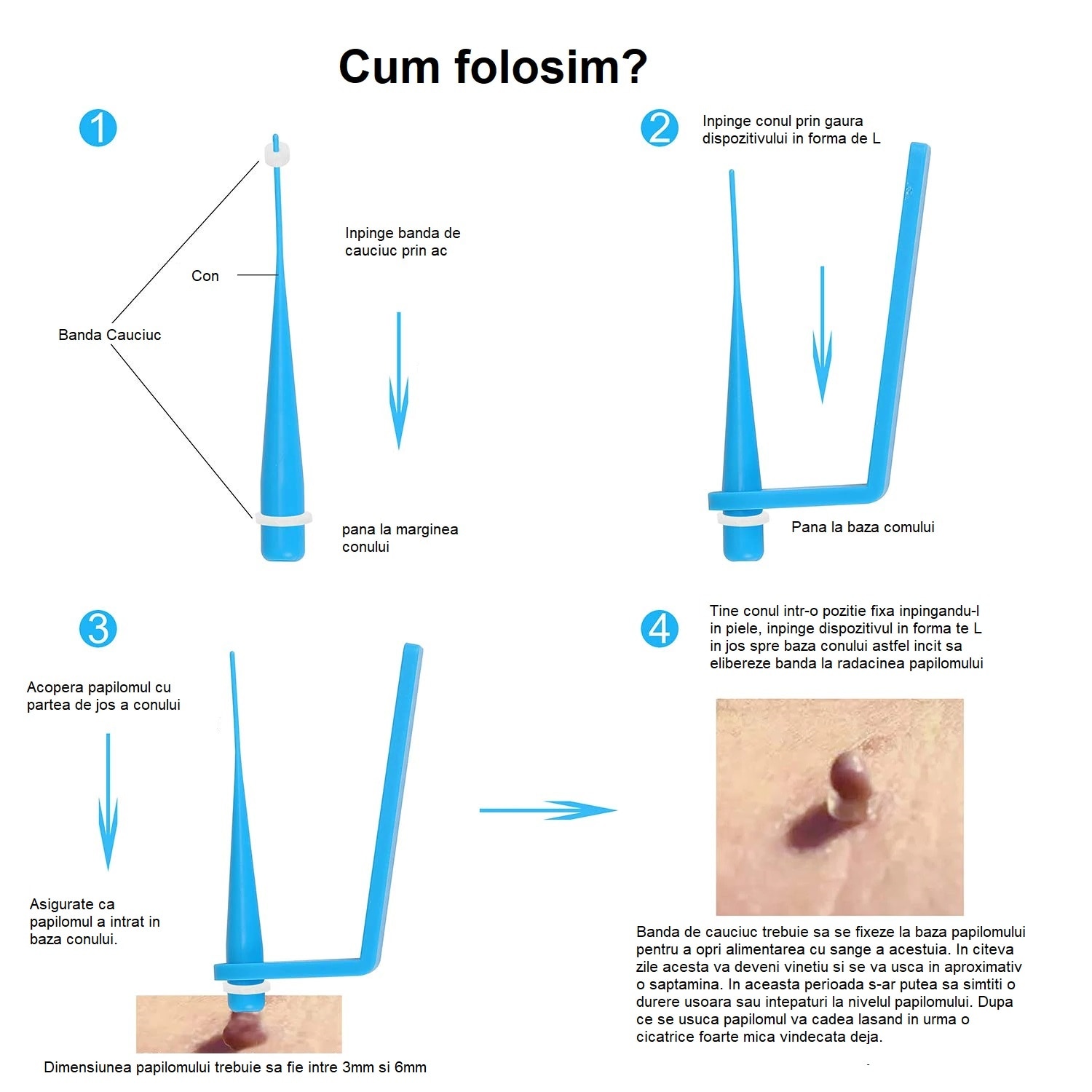 La locul îndepărtării papilomului