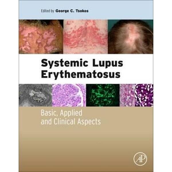 Systemic Lupus Erythematosus
