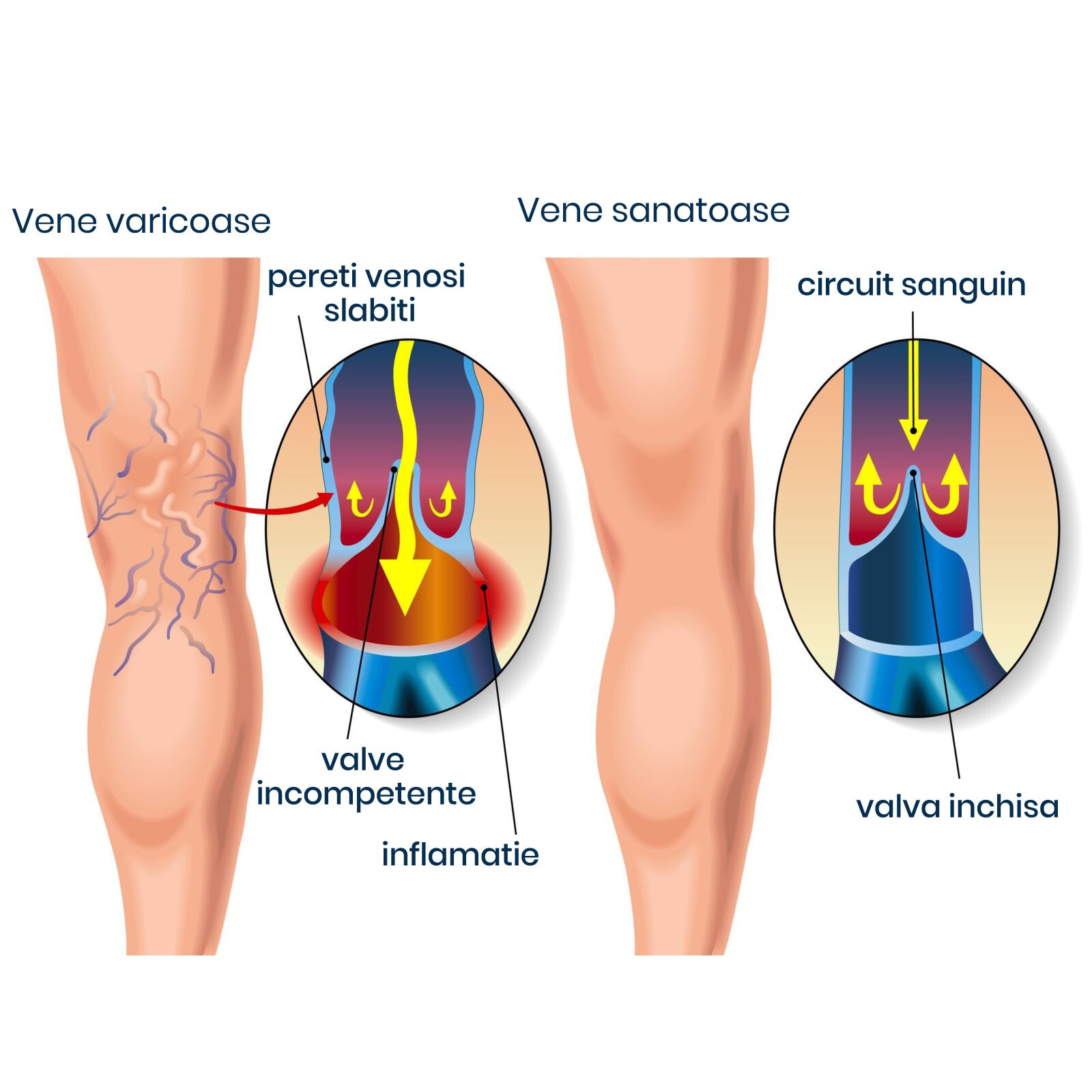 cum de a preveni etapa iniiala de varicoza colani pentru tratamentul venelor varicoase ale piciorului