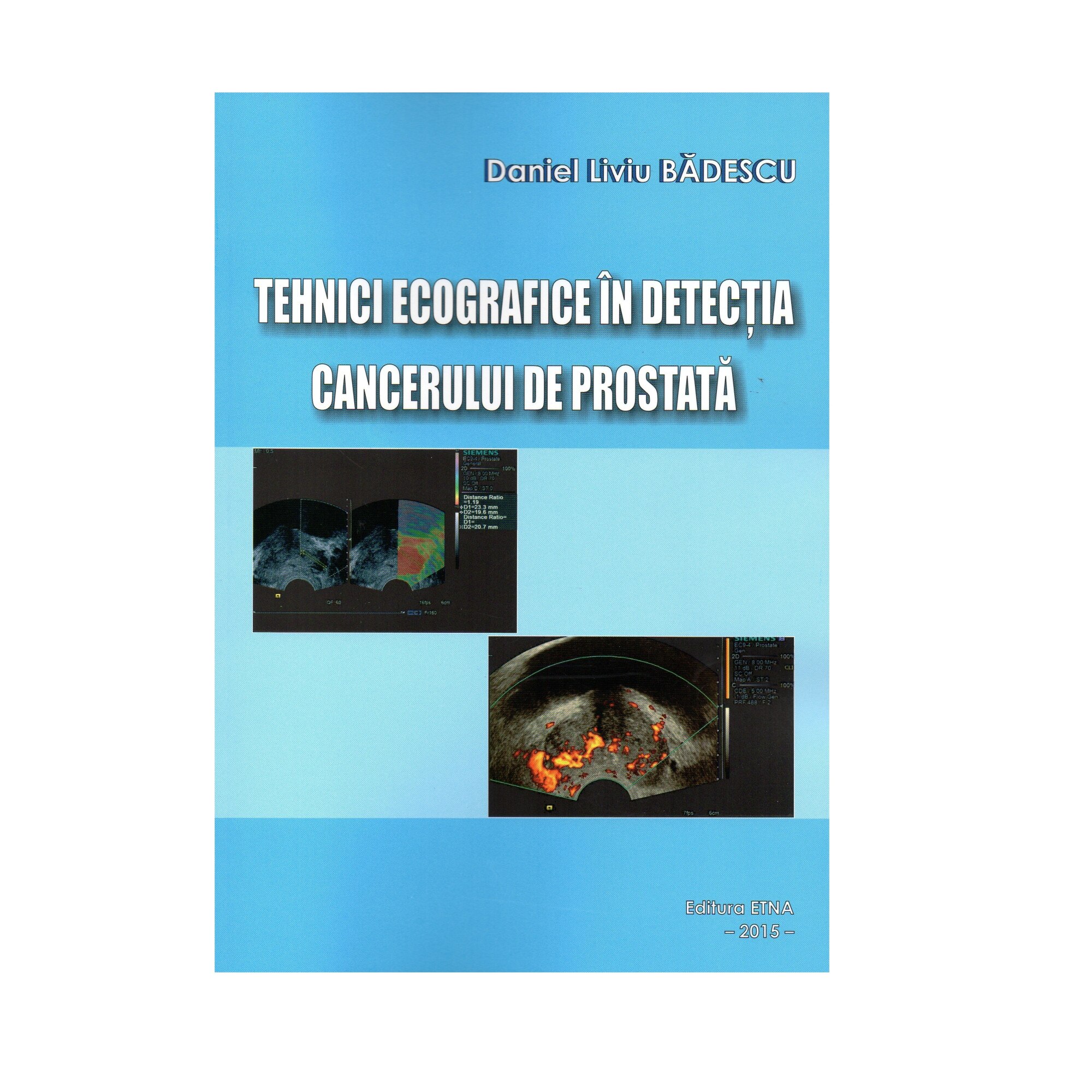 Tehnici ecografice in detectia cancerului de prostata, Daniel Liviu Badescu, Brosata, 166 pagini