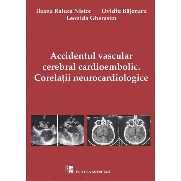 Accidentul vascular cerebral cardioembolic. Corelatii Neurocardiologice - Ileana Raluca Nistor