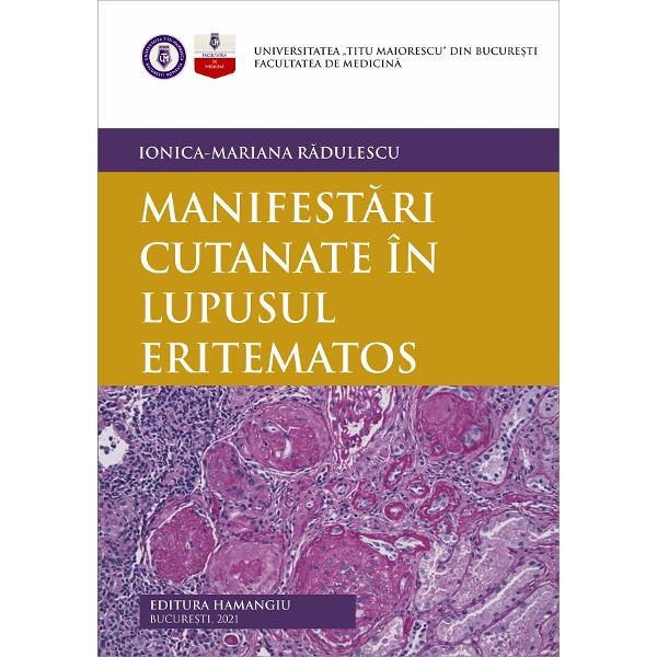 Manifestari cutanate in lupusul eritematos - Ionica-Mariana Radulescu
