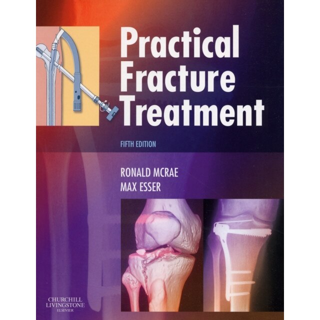 Practical Fracture Treatment de Ronald McRae