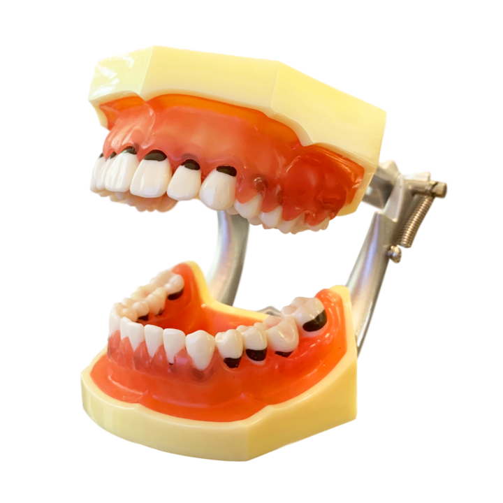 Model boala parodontala cu dinti detasabili cu surub - 4023