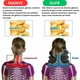 Guler Cervical Moale si Gonflabil pentru Spondiloza si Hernie Cervicala Maro