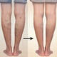 Ciorapi compresivi medicinali, pana la coapsa, cu varf deschis, clasa II, 23-32 mmHg, Bej, marimea M