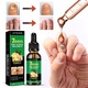 Dispozitiv laser pentru tratarea ciupercii unghiilor, reparatie unghii de la maini si picioare, 4.3x6.6 cm + 30 ml solutie de ingrijire cu ghimbir