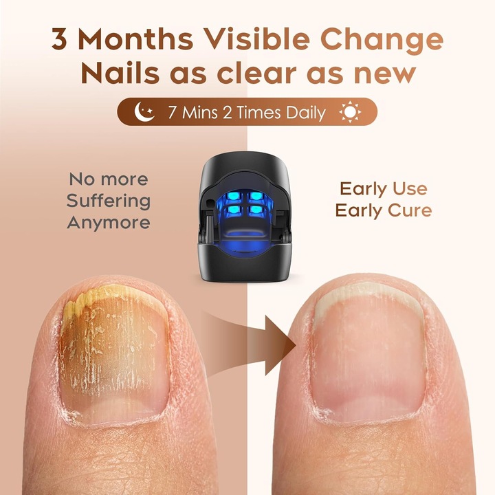 Лазерно устройство за лечение на онихомикоза, BIGLISTENING®, за бързо лечение на гъбички по ноктите на краката, подходящо за увредени, обезцветени, дебели нокти, подходящо за домашна употреба, зареждане чрез USB, преносимо, черно