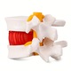 Model anatomic uman pentru hernie de disc lombar, 1.5x dimensiune reala, 2 discuri flexibile, WALALLA