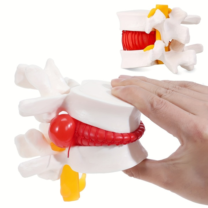 Model anatomic uman pentru hernie de disc lombar, 1.5x dimensiune reala, 2 discuri flexibile, WALALLA