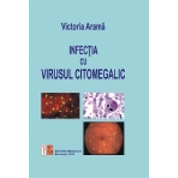 Infectia cu virusul citomegalic - Victoria Arama