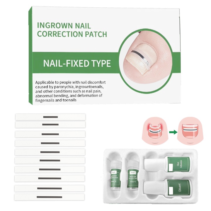 Комплект за лечение на враснали нокти на краката, LXNZUHN, Комплект за премахване на нокти на краката, 10 листа от нитинолова сплав, 2 бутилки лепило