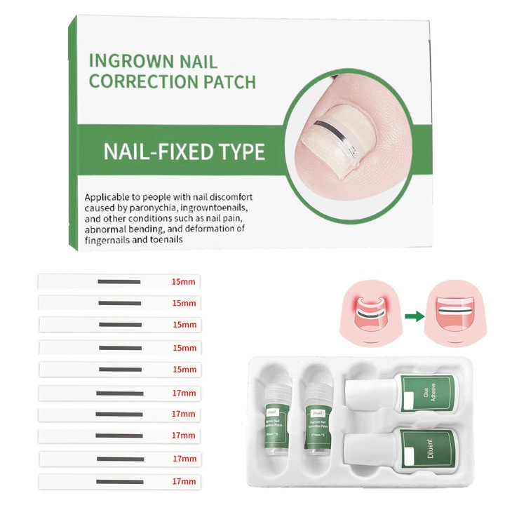 Set tratament unghii incarnate, LXNZUHN®, kit de indepartare unghii, 10 foi din aliaj de nitinol, 2 sticle de adeziv